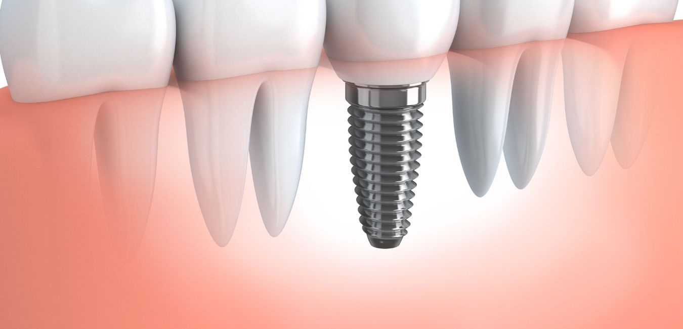 Affordable Dental Implants: What You Need to Know