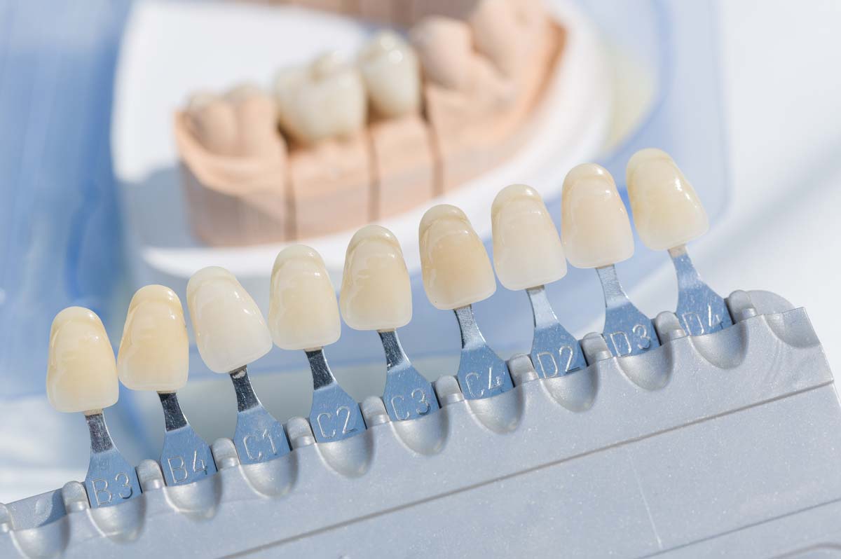 A Comprehensive Guide to Porcelain Veneers and Dental Extraction in Houston