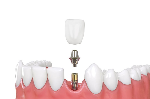 What To Look For When Choosing A Dental Implant Dentist In NYC?