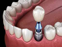 How Do I Find Dental Implant Specialists Near Me?