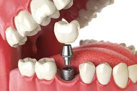 What Is The Dental Implant Procedure Like And How Long Does It Take?