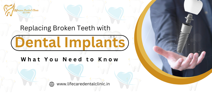 Replacing Broken Teeth with Dental Implants: What You Need to Know