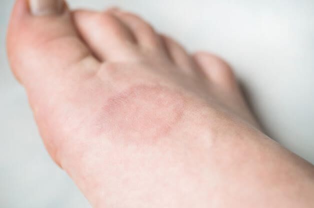 Discovering the Mystery: Granuloma Annulare Under Skin Explained